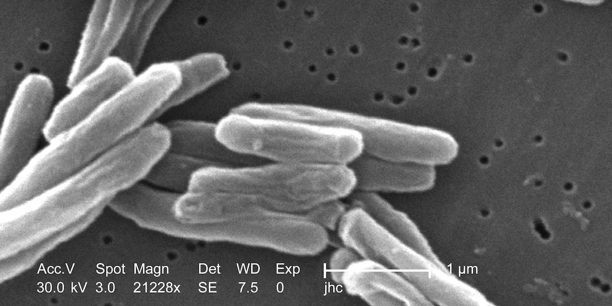 Tuberculosis found in Union County student: What you need to know Tuberculosis found in Union County student: What you need to know